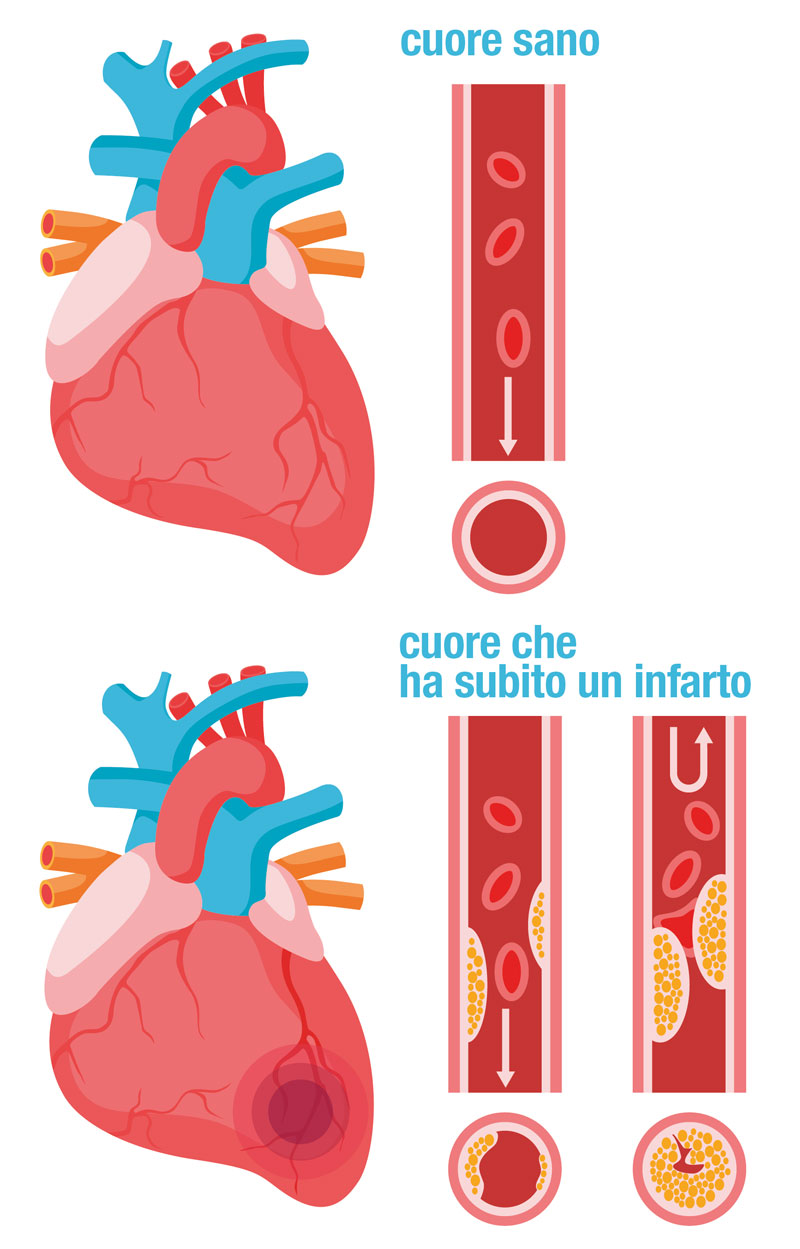 l'infarto del miocardio